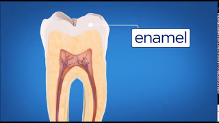 Five stages of Tooth decay [upl. by Aelat]