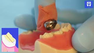 Stainless Steel Crown Technique for a Primary Molar Tooth [upl. by Lukey]