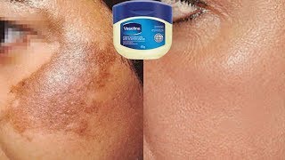 How To Use Vaseline To Remove Skin Pigmentation In Just 10 Days  Home Remedies [upl. by Orna406]