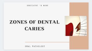 DENTAL CARIES ZONES [upl. by Normand]