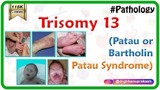 Trisomy 13 Patau or BartholinPatau syndrome  Causes  Diagnosis  Treatment [upl. by Klockau750]